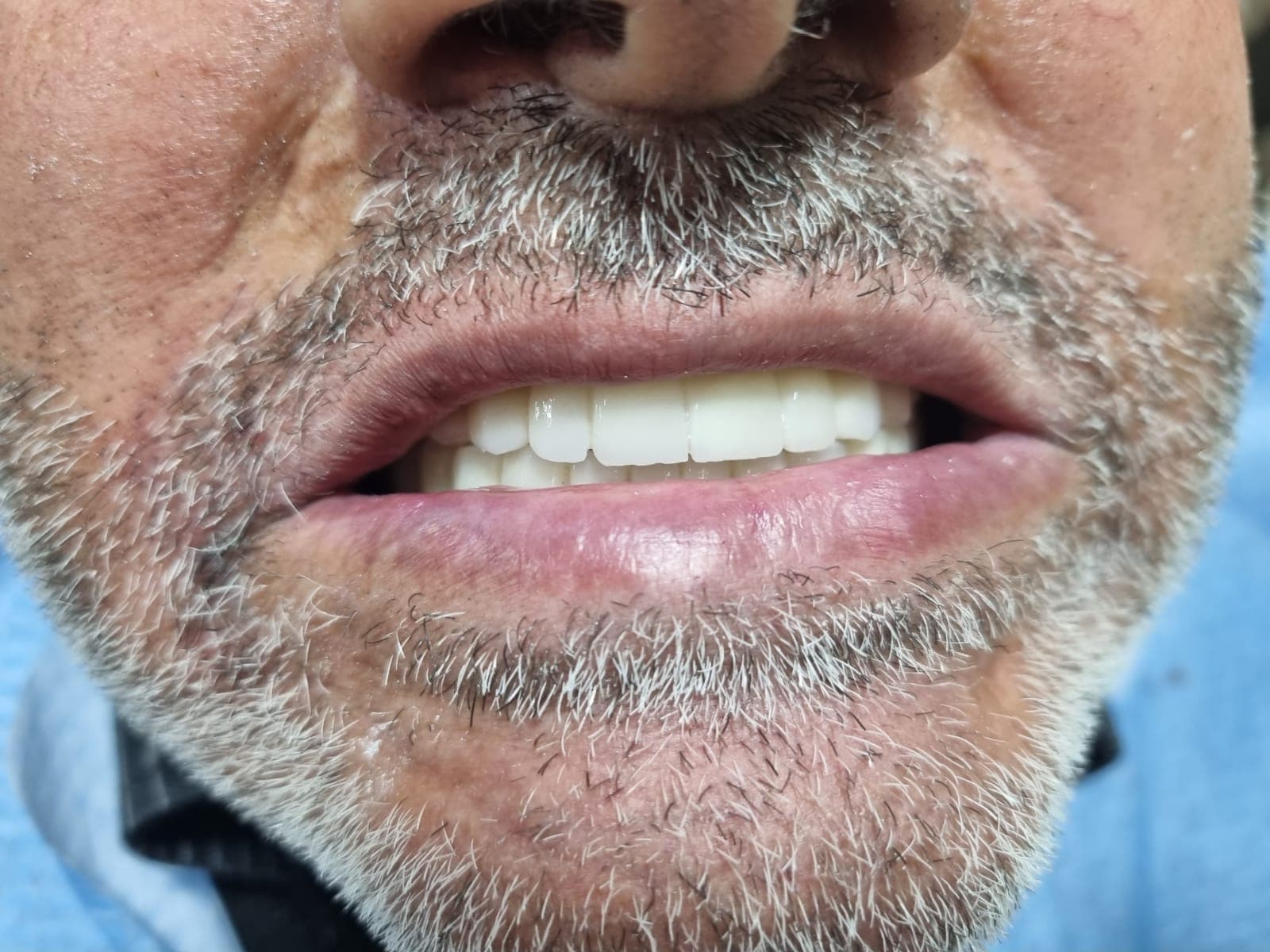 Имплантация — после лечения