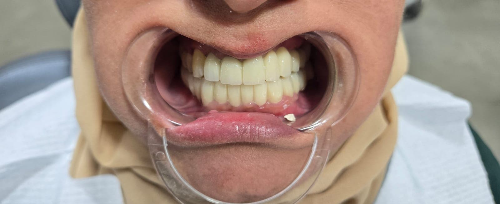 Протезирование — после лечения