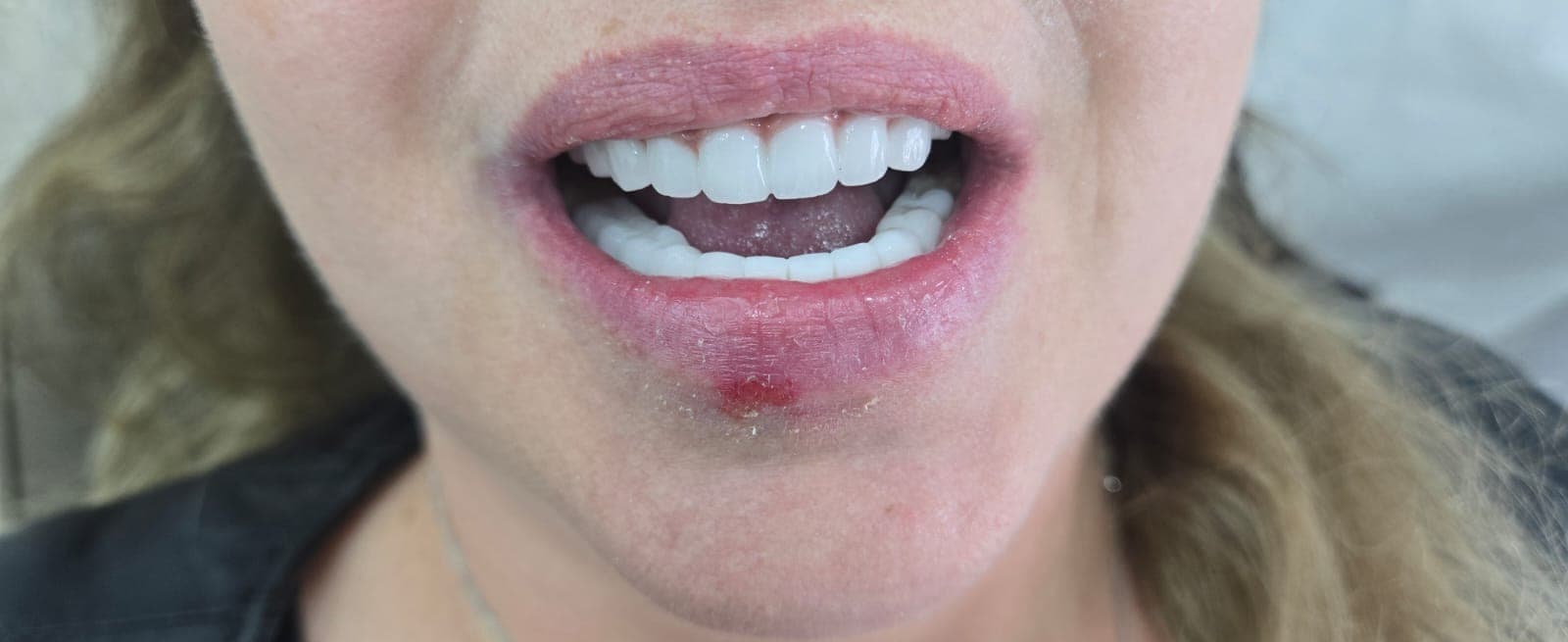 Гигиена и чистка — после лечения